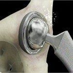 Wage Earners Get High-tech Help from Dept. of Labor 16 Hip Replacement